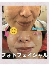 サロン ド ピュール(SALON DE PURE)/光フェイシャル/シミケア/浜松