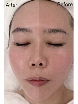 ジョジョイー(JoJoYEE)/フェイシャルBefore／After