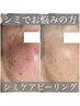【頑固なシミ改善】30代以上からのシミ予防☆シミケアピーリング
