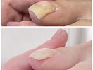 【巻き爪】綺麗な形でネイルを☆