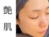 ＜ご褒美小顔コース＞小顔矯正＋カーボキシー 60分　¥11000