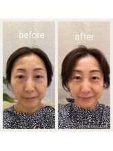 ラ ヴィ リッシュ(La vie riche)/indiba facial ビフォアフ☆