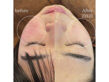 フローレント(Florent)/光フェイシャル