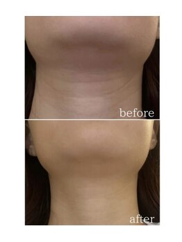 アエ メゾン(ae maison)/二重アゴ/顎下