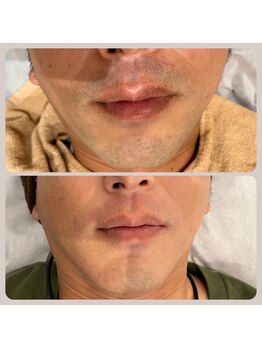 コボ ヘア アンド エステティック(COVO hair & esthetic)/毎朝の自己処理が楽になりました