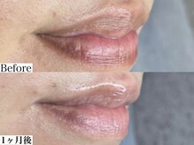 エモーショナル 姫路(Emotional)/ルメラ◎リップのくすみ改善