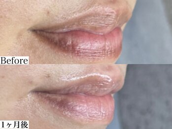 エモーショナル 姫路(Emotional)/ルメラ◎リップのくすみ改善