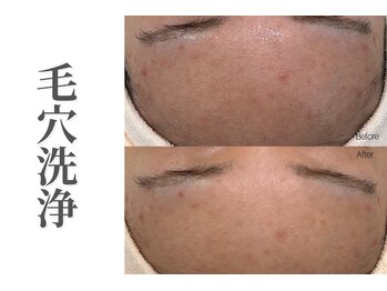 エトレ(etre)/毛穴/ニキビケア/フェイシャル