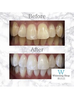 ホワイトニングショップ 秋田店/【before after】 美白