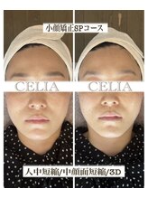 セリア(CELIA)/小顔　中顔面短縮