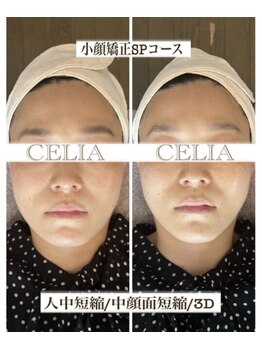 セリア(CELIA)/小顔　中顔面短縮