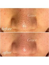 グレイス/頑固な毛穴汚れ、角栓に