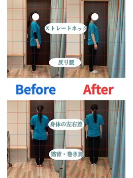 ハル鍼灸整骨院 池田院(HALU鍼灸整骨院)/姿勢・骨盤矯正ビフォーアフター