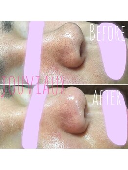 ジョビオ 足利サロン(JOUVIAUX)/毛穴ケア