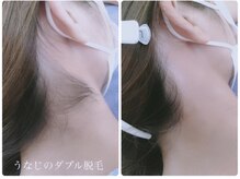 サロン ド モア(salon de MORE)/うなじのダブル脱毛