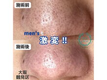 リッカロッカ(RIKKA&ROCCA)/men'sも激変した毛穴ケア