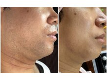 サロン ヌーク(salon Nook)/ヒゲ脱毛/メンズ脱毛