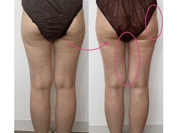 リリー(Lily)/セルゼロ下半身