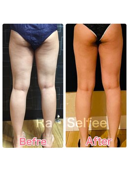 ラ セルフィー(Ra Selfee)/凸凹セル脂肪を改善