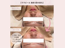 ラシック(La chic)/毛穴洗浄/ララピール大阪心斎橋