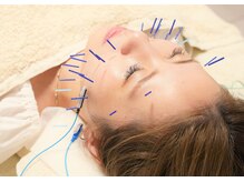 アモ(amo)/美容鍼