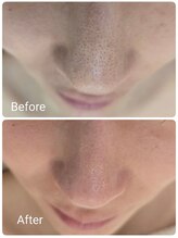 サロンド シェリー(Salon de Cherie)/毛穴エクストラクション