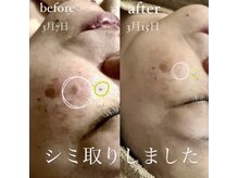 コスメ デ グレース(cosme de greace)/小さいシミは数回で変化を実感！