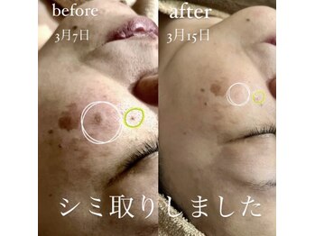 コスメ デ グレース(cosme de greace)/小さいシミは数回で変化を実感！