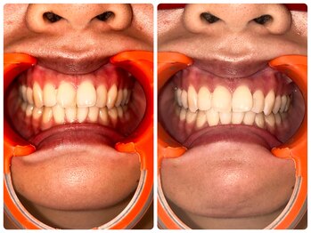 コナホワイトニング 神保町/ホワイトニング