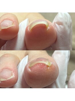 セラキュアネイル(Theracure nail)/巻き爪緩和で痛みも緩和