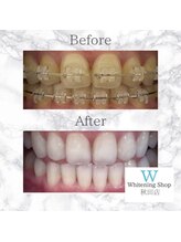 ホワイトニングショップ 秋田店/【before after】 美白