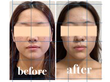 クリーム 京都店(Cream)/アゴの形を変える希少なエステ