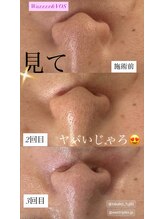 パタティパタタ(PatatiPatata)/唯一無二のイノスピキュール