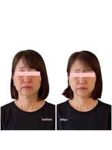 ニコディア(nico-dia)/美容鍼