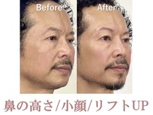 ラプリ 札幌ル・トロワ店/隆鼻+輪郭矯正40分 20回