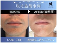 メンズビービー 福井高柳店(MEN'S BB)/ヒゲ脱毛施術事例