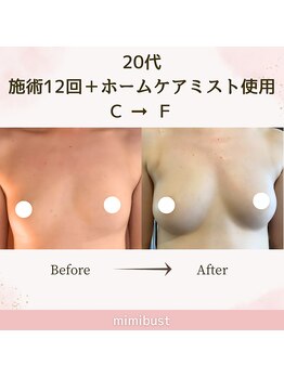 ミミバスト(mimibust)/バストアップBeforeAfter