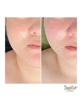 サプナジー(Suppnrgy)/小顔コルギ