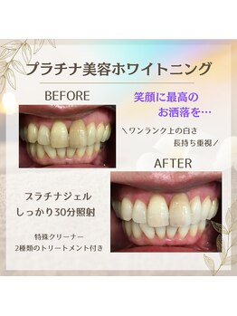 ホワイトニングプラス(Whitening+)/プラチナ美容ホワイトニング
