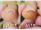 巻き爪補正でいたみ軽減！