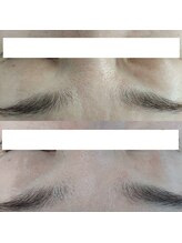 ヴェルシック(Belchic)/眉間の毛穴とシワも改善できる