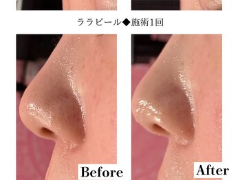 フレイヤ(FREYA)/ララピールBefore→After