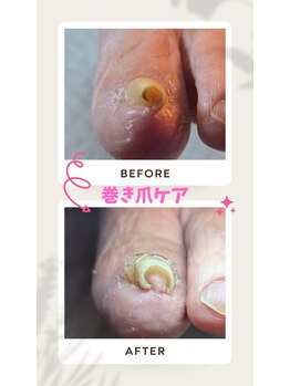 ドクターネイル爪革命 恵庭店/ストロー型巻き爪