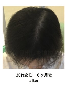 イーズ/リバイタ 梅田本店/【case8】２０代女性 after