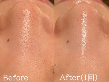 セレブリボーン 大阪ボーテ/ハイドロ毛穴洗浄