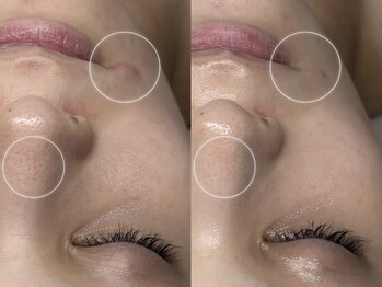 キヌ(KINU)/症例写真（赤み）