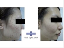 フェイシャルスタイリストサロン 四谷店/ケア例(11)