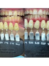 トウキョウスワーズ 池袋店(TOKYO SWRS)/#ホワイトニング #池袋 #渋谷