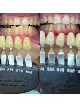 トウキョウスワーズ 池袋店(TOKYO SWRS)/#ホワイトニング #池袋 #渋谷