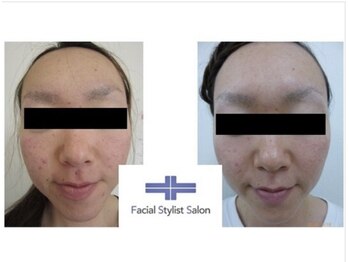 フェイシャルスタイリストサロン 四谷店/ケア例(12)